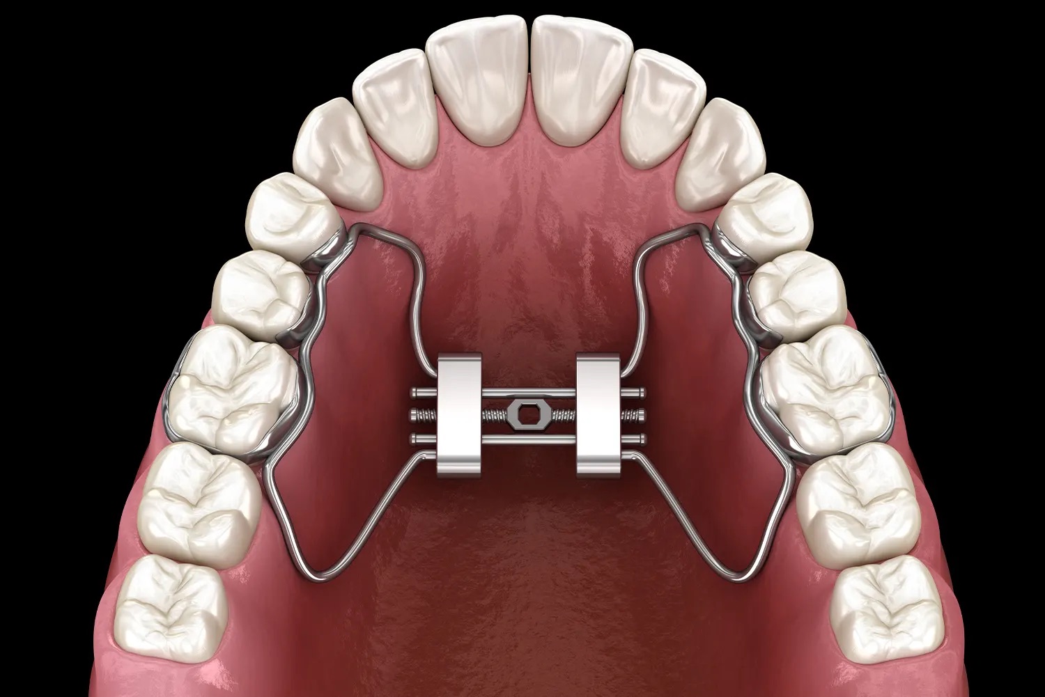 digital rendering of an upper palate expander