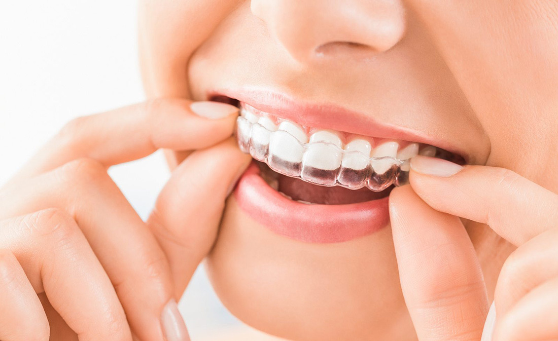 woman holding Invisalign tray to her mouth