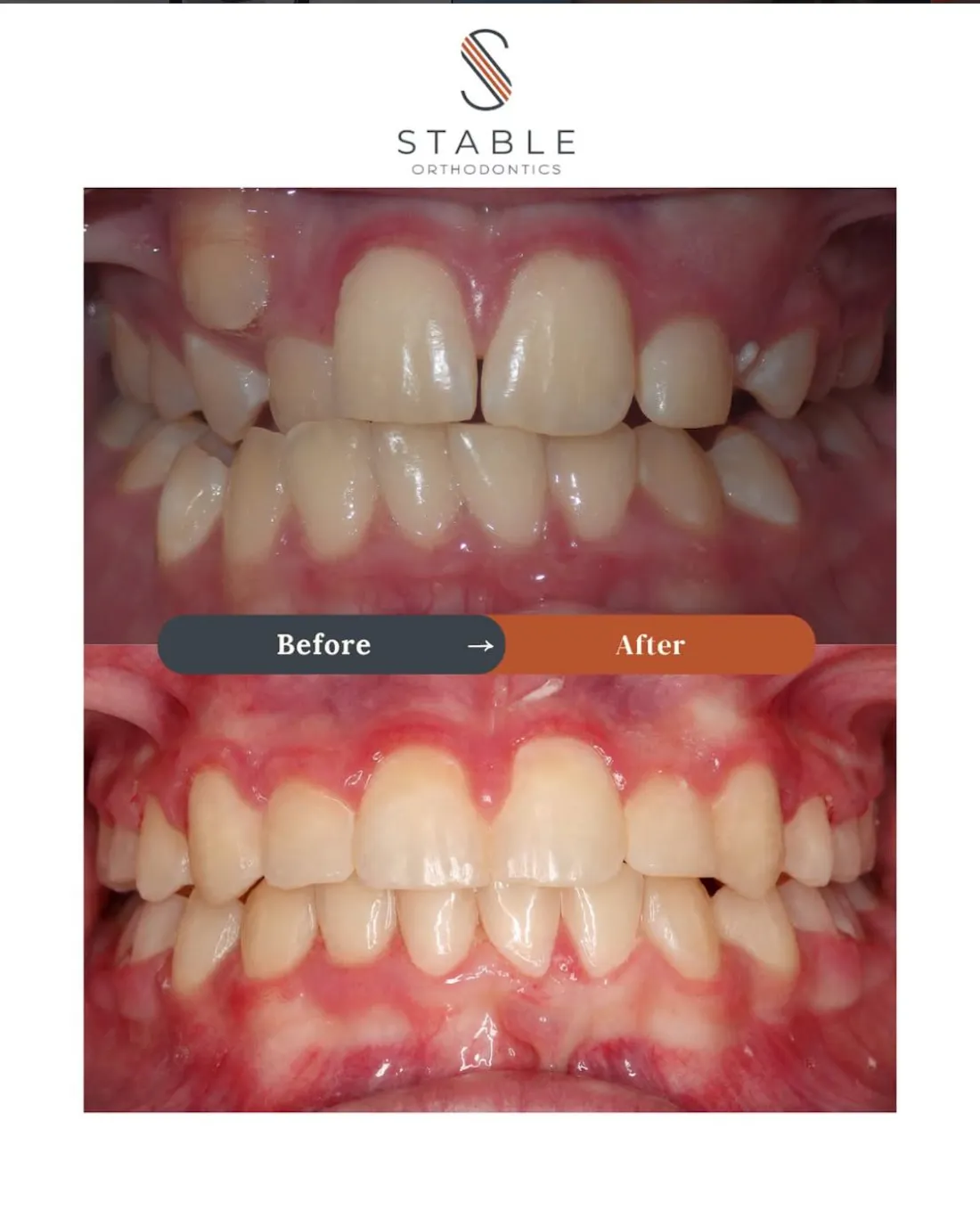A Stable Orthodontics patient before and after treatment