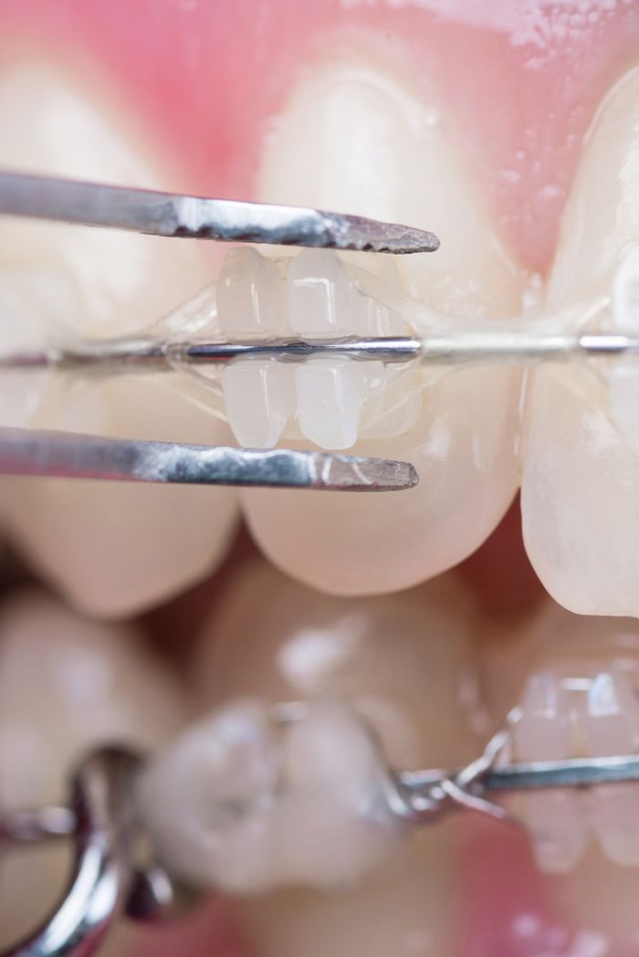 close up of brackets and braces