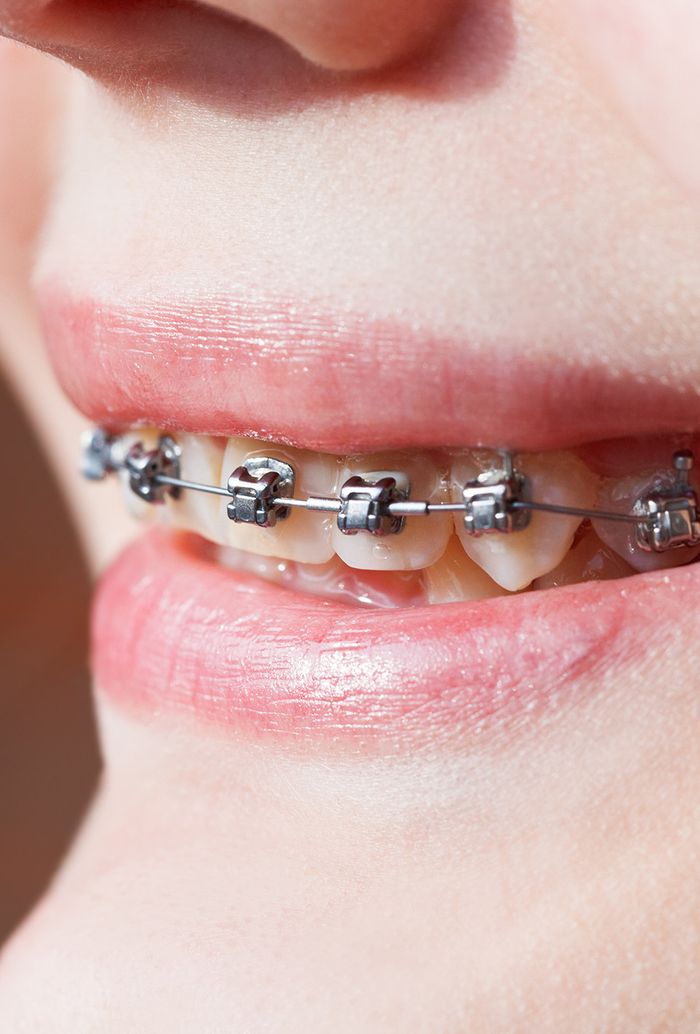 close up of braces