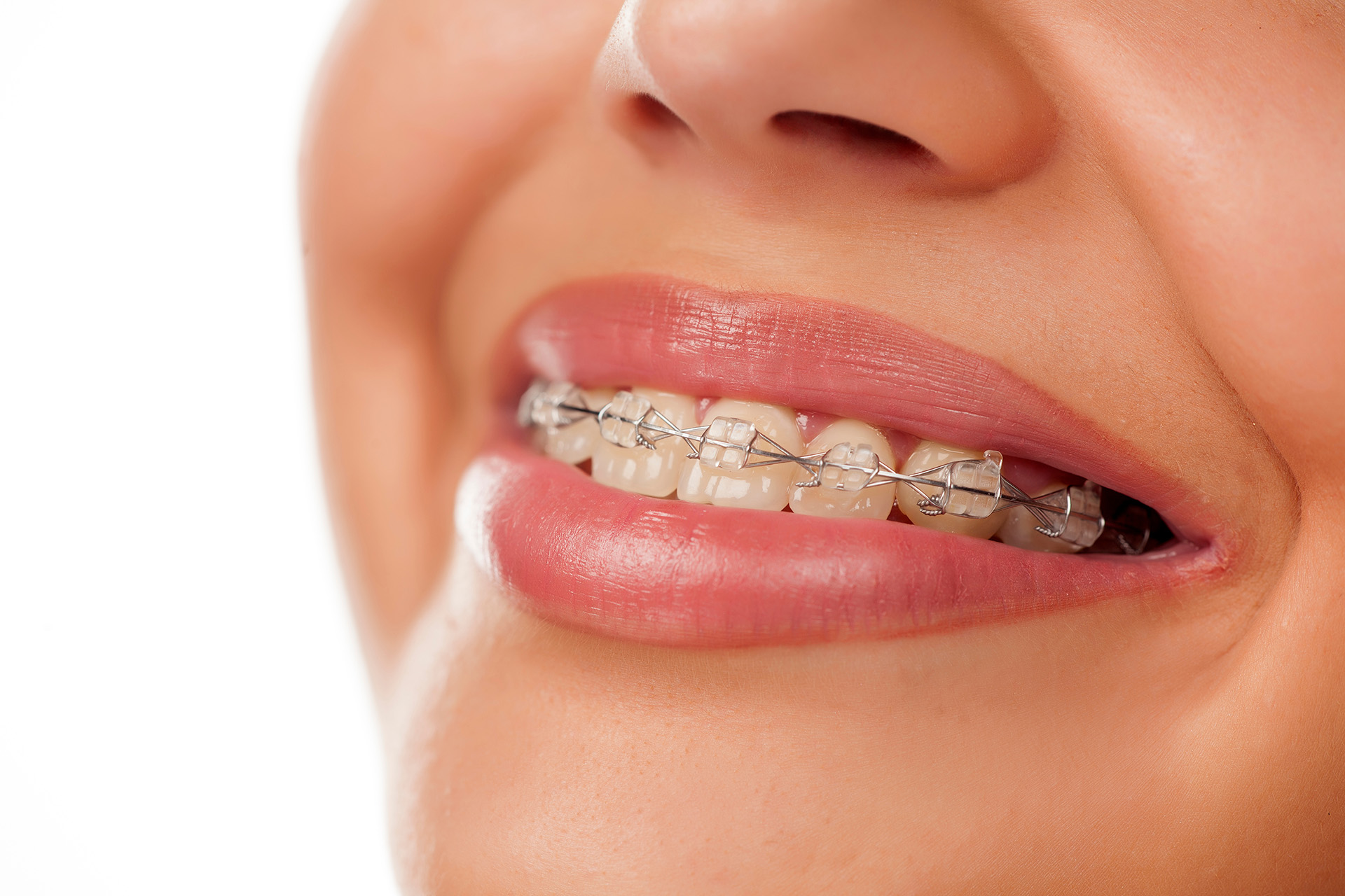 woman with braces