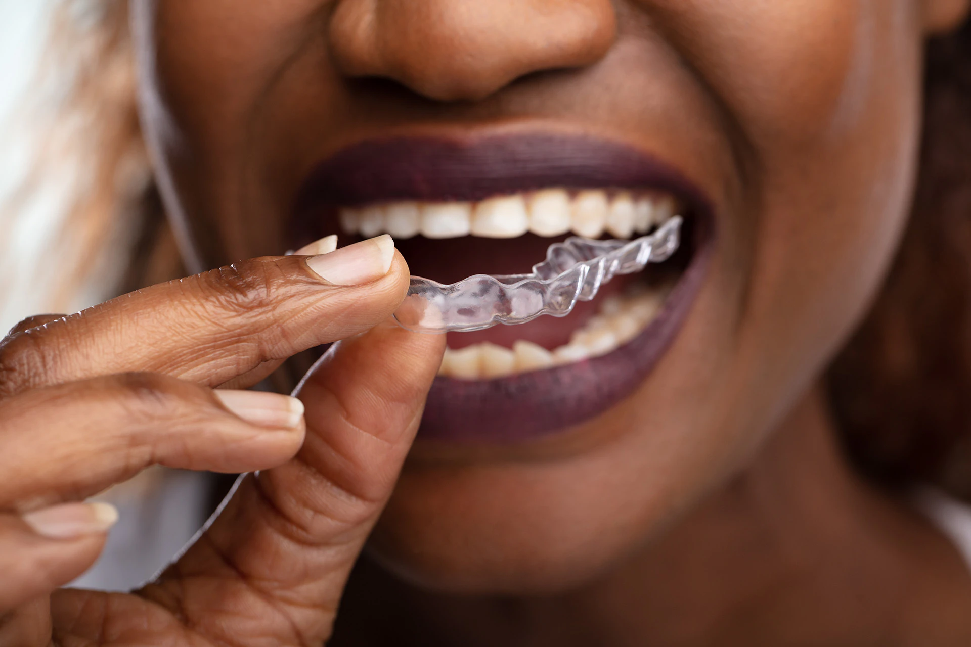 woman holding invisalign tray