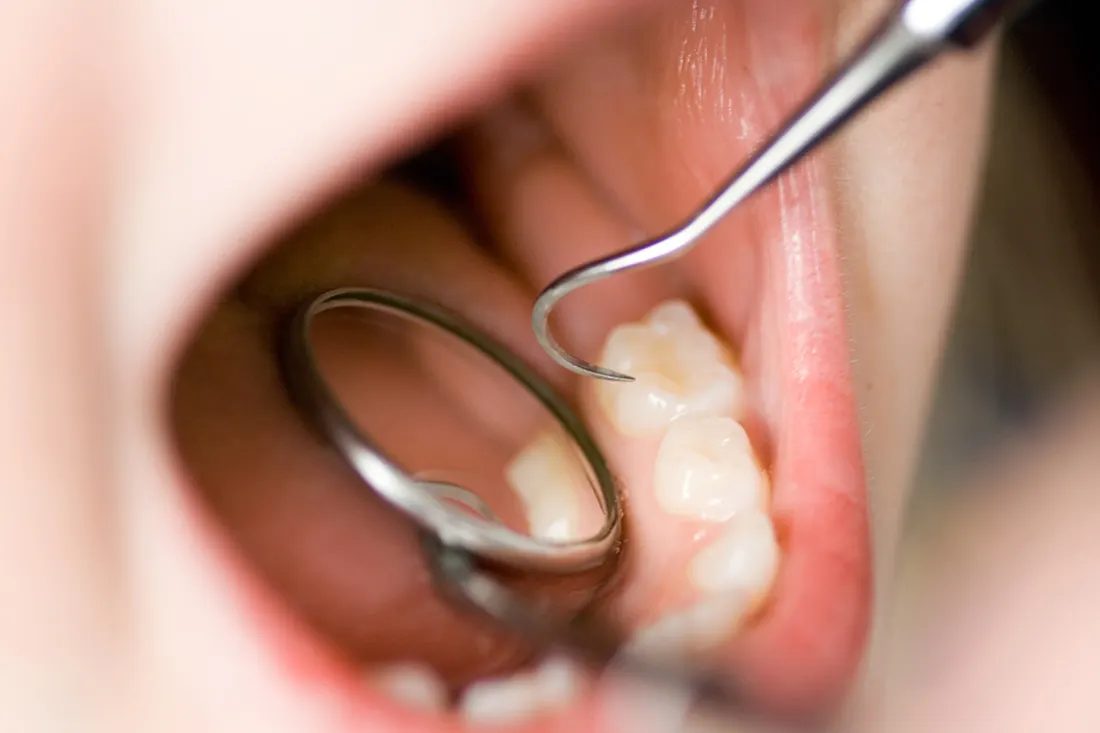 Child mouth during dental exam