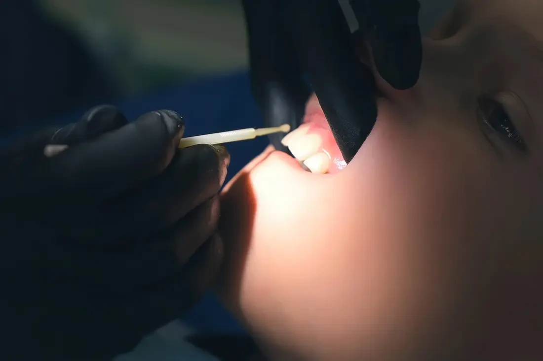 Pediatric fluoride treatment
