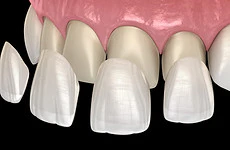 digital rendering of veneers