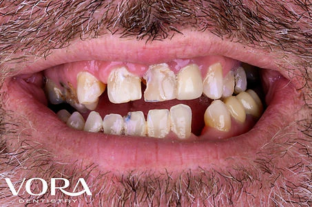 Close up photo of Real Patient Before