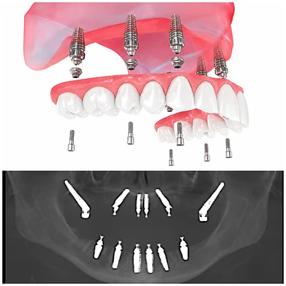 Digital rendering of All-on-6 implants over an xray of a mouth with All-on-6 implants