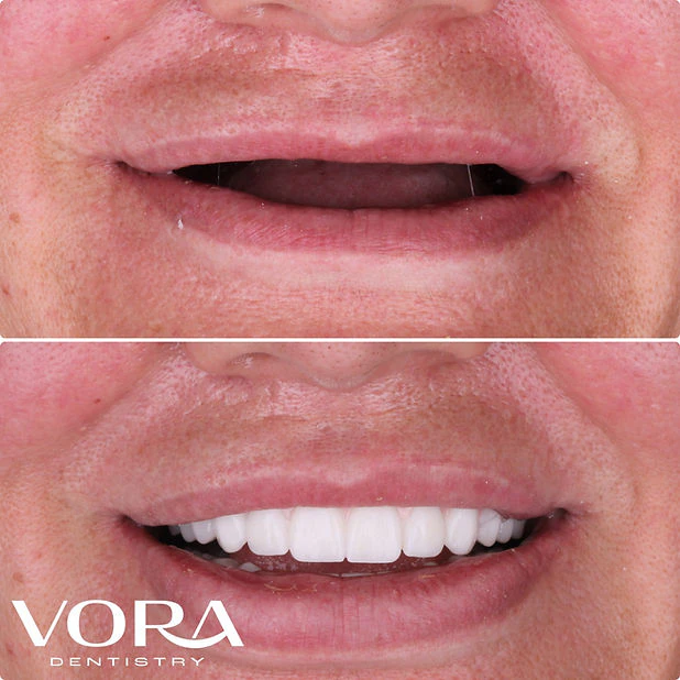 Real VORA Dentistry patient before & after Case 3