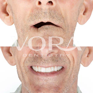 Real VORA Dentistry patient before & after Case 2