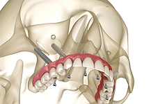 Pterygoid Implants