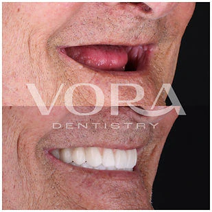 Real VORA Dentistry patient before & after Case 1