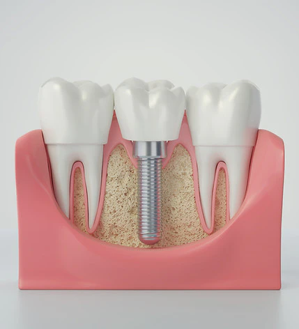 Dental implant in jaw digital rendering