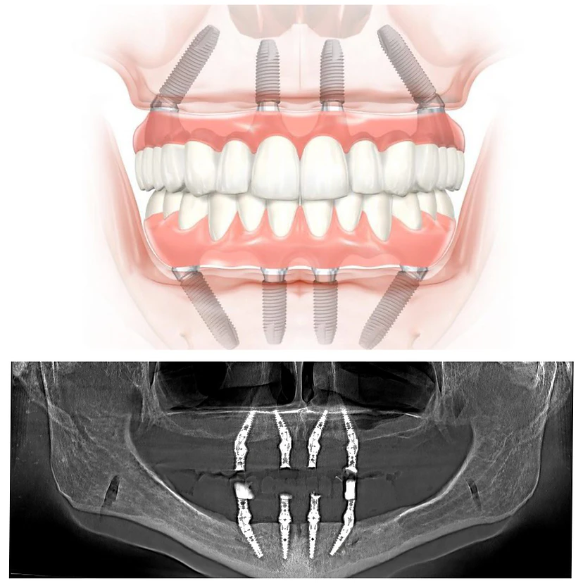 digital rendering of All-on-4 Implants above an xray of a mouth with All-on-4
