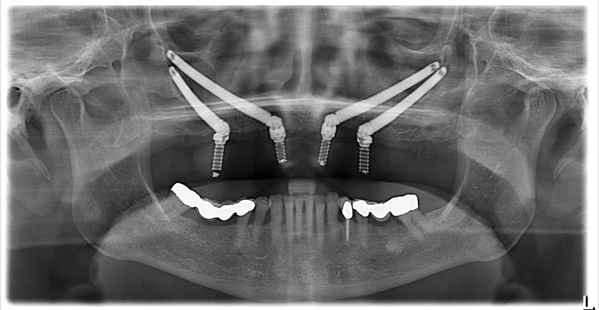 Zygomatic Implants