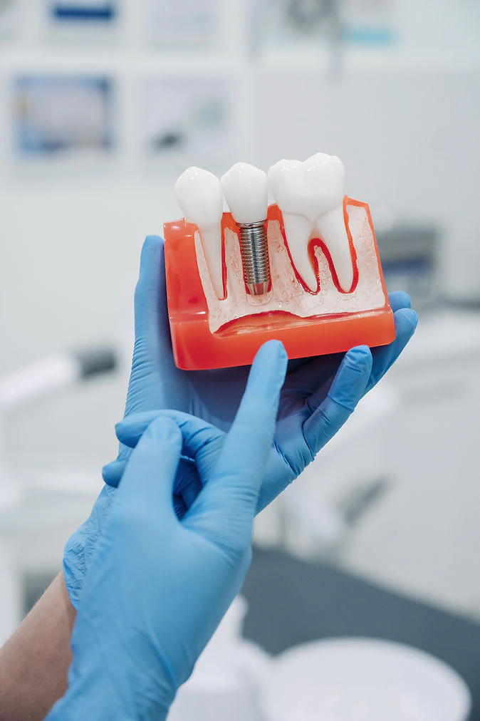 blue gloved hand holding a model dental implant