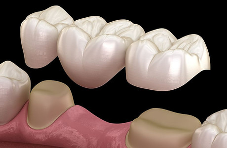 Implant-Supported Bridge