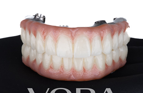 Full-Arch Restoration (All-on-X)