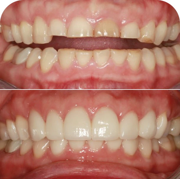 Before and after smile, East Brainerd Dentistry patient