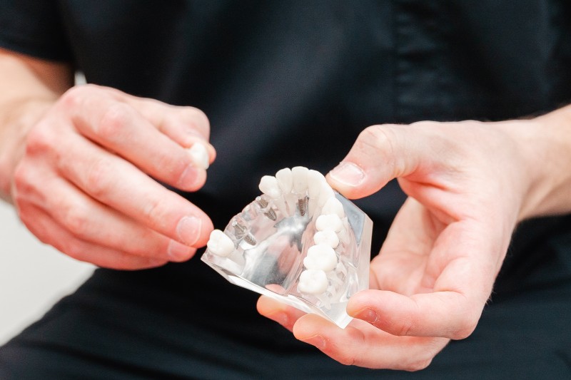 Mold of dental implants