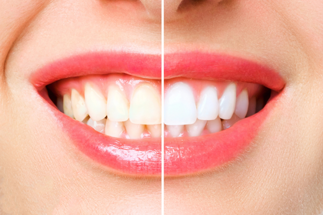 Woman smiling w/ teeth whitening