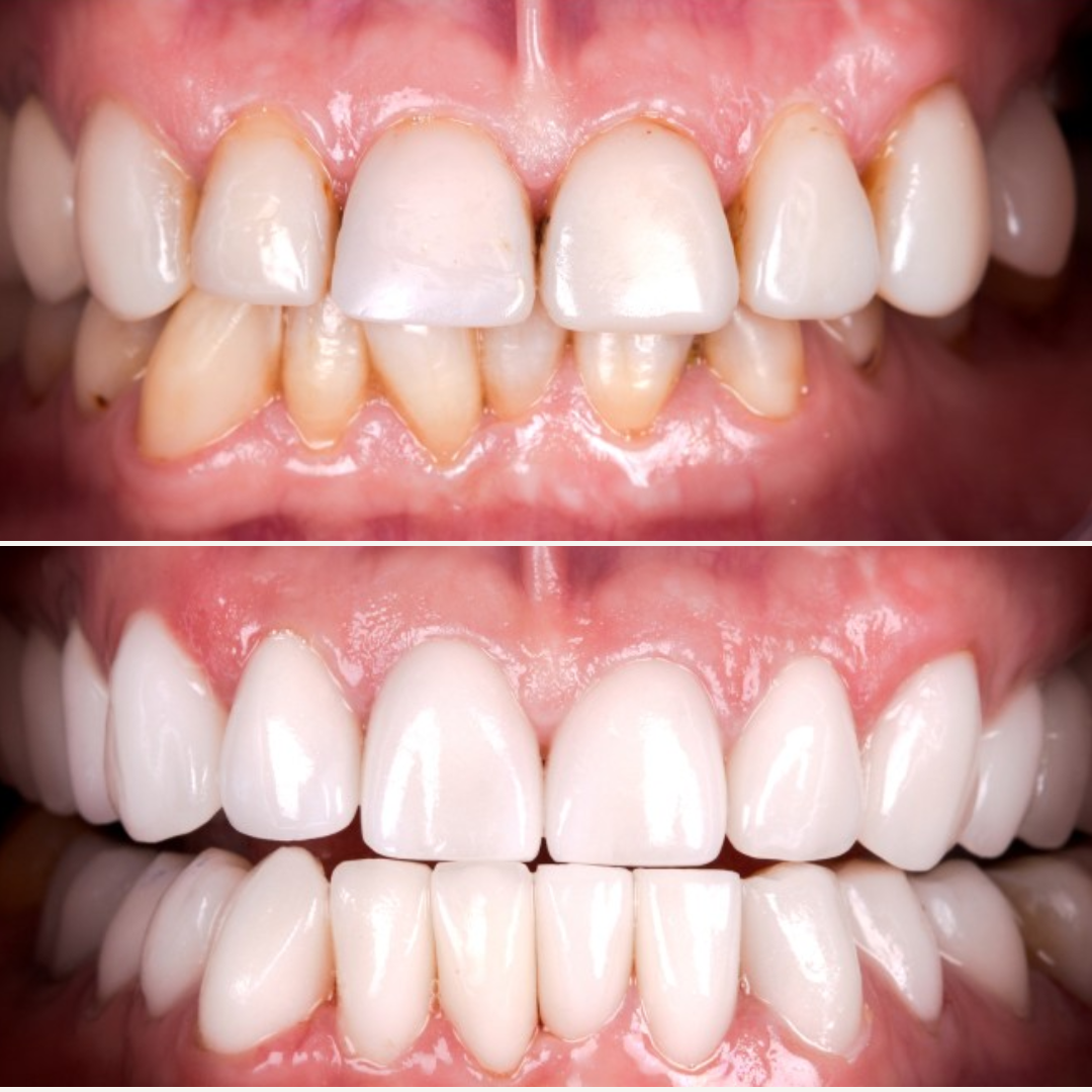 before and after smile makeover